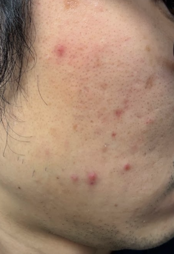 ニキビ・ニキビ跡の肌